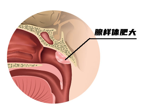 腺样体肥大.jpg